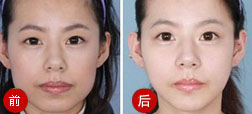 面部整形前后对比图_改脸型对比图_颧骨整形手术效果